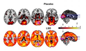 Brain scan on LSD vs placebo